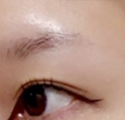 시술 전